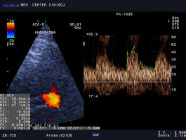 Ultrasound - anevrizma